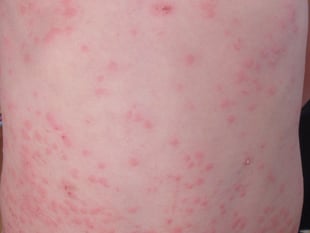 Drop-in for your MMR vaccine